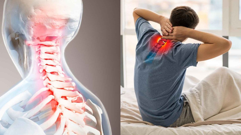 Cứ 10 người Việt trên 40 tuổi lại có 6 người mắc căn bệnh này, tưởng chừng vô hại nhưng có thể dẫn đến bại liệt, tàn phế
